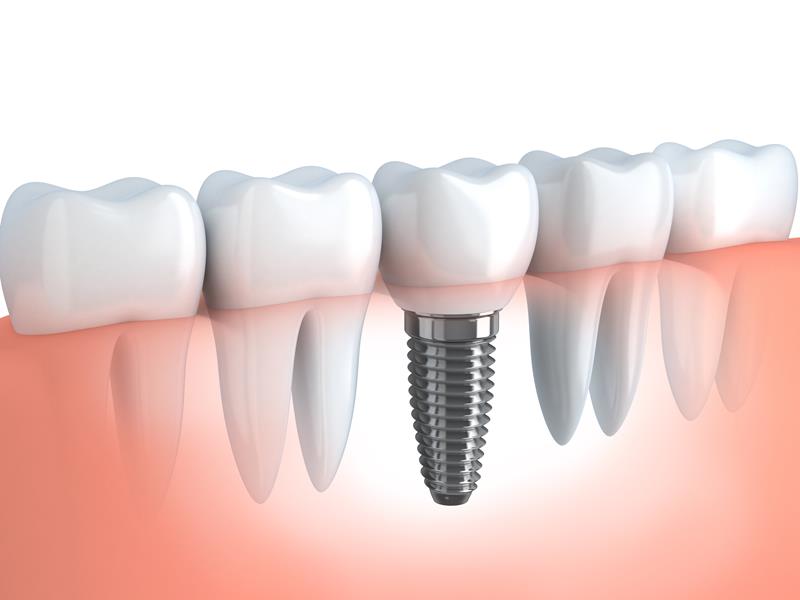 Dental Implants Woodbridge, VA