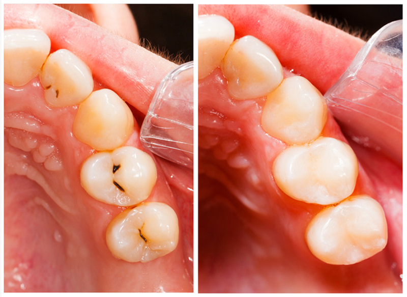 Fillings  Woodbridge, VA