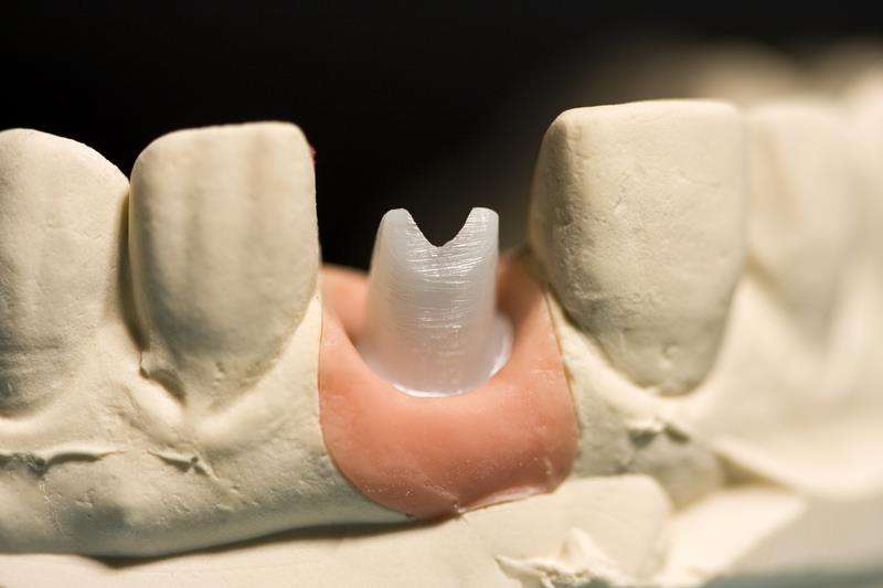 Implant Restoration  Woodbridge, VA