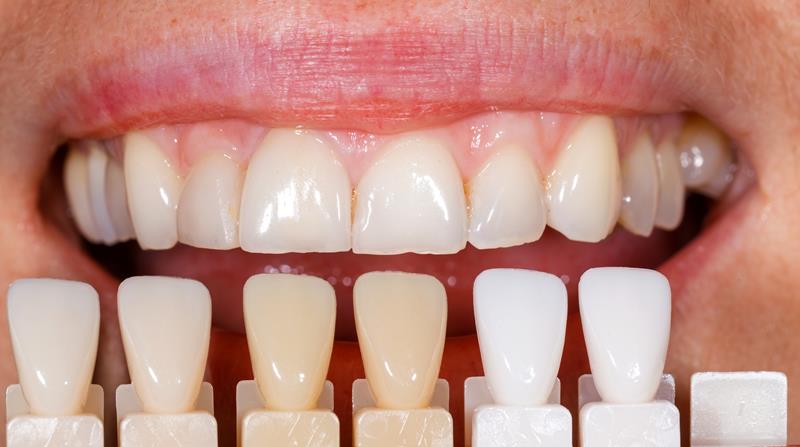 Veneers  Woodbridge, VA
